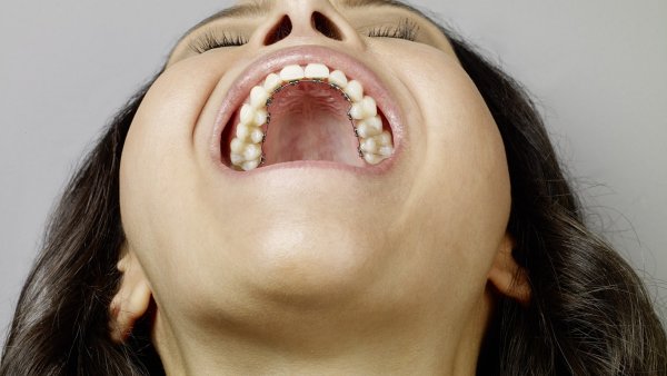 Готическое твердое небо