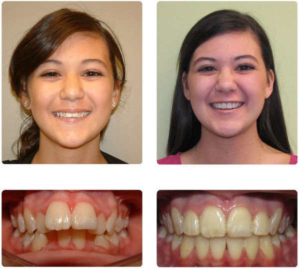 Девушки с брекетами до и после