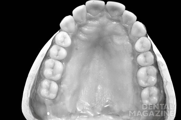 Расщелина неба и альвеолярного отростка