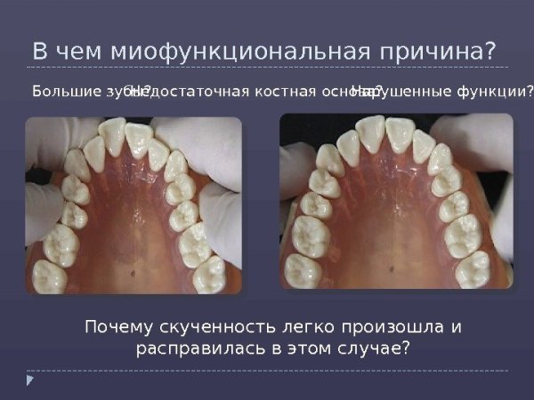 Ринолалия расщелина твёрдого неба