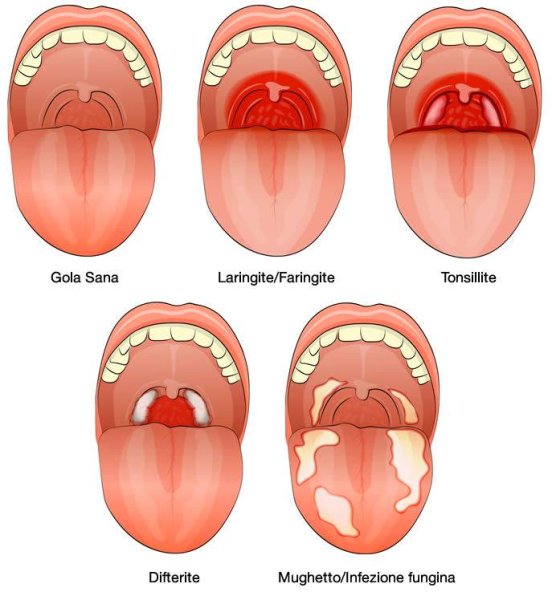 Пьера Робена микрогнатия