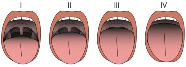 Готическое небо синдром Шерешевского