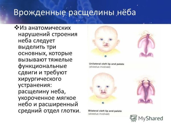 Врожденные расщелины верхней губы и неба