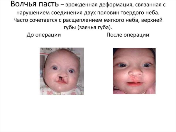 Заячья губа и Волчья пасть