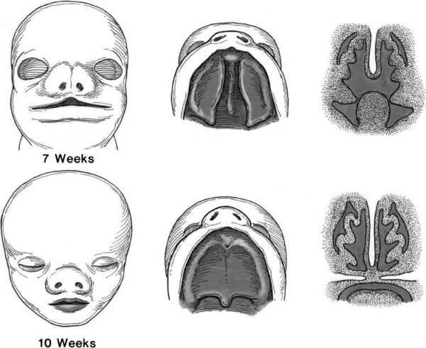 Ринолалия Волчья пасть