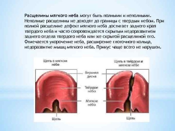 Расщепление мягкого и твердого неба