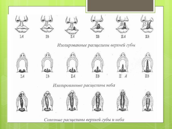 Врожденная расщелина мягкого и твердого неба