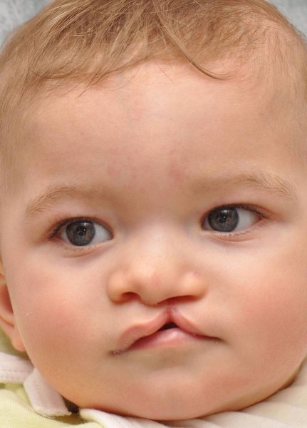 Ринолалия расщелина твёрдого неба