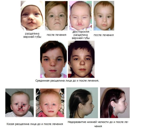 Врожденная расщелина твердого неба
