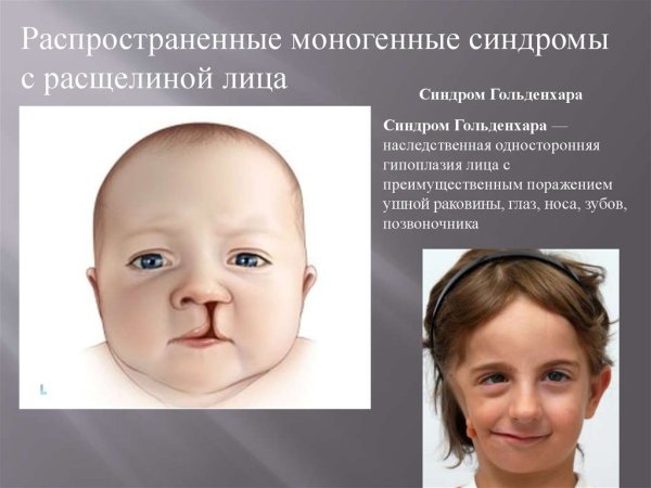 Расщелина неба и альвеолярного отростка