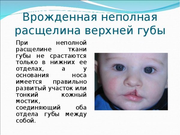 Хейлосхизис (заячья губа)