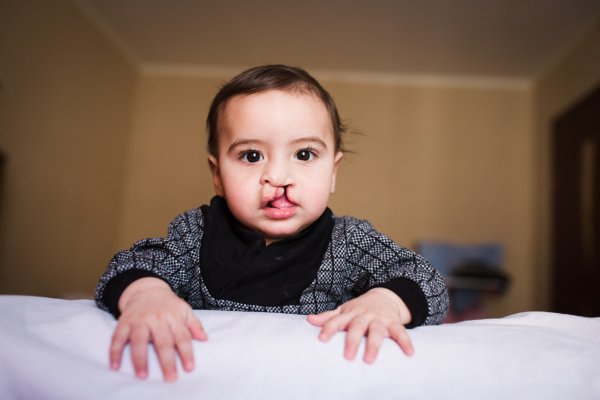 Субмукозная расщелина мягкого неба