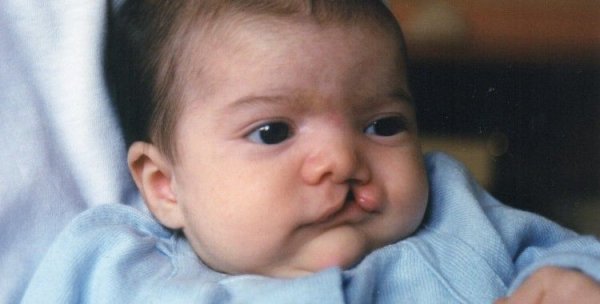 Врожденный порок, расщелина неба,