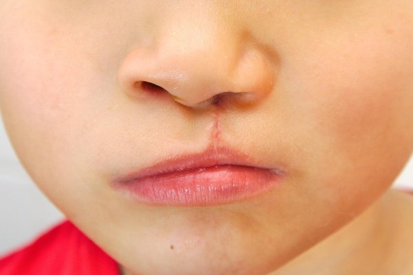 Ринохейлопластика заячья губа