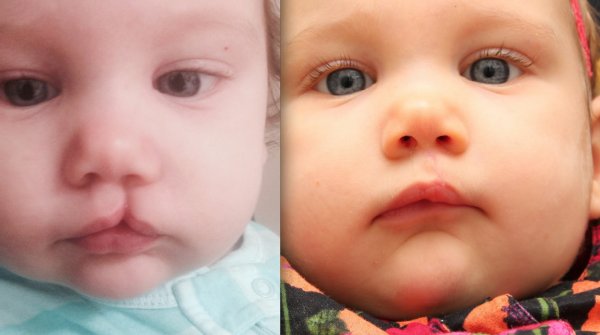 Классификация расщелин альвеолярного отростка