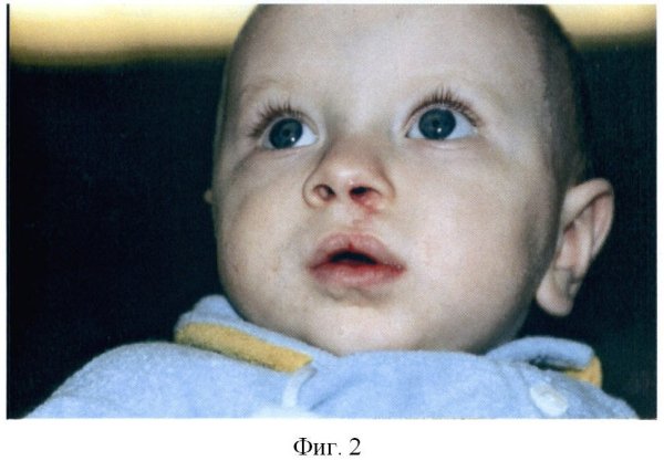 Врожденная расщелина верхней губы двусторонняя