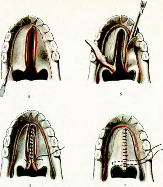 Заячья губа и Волчья пасть