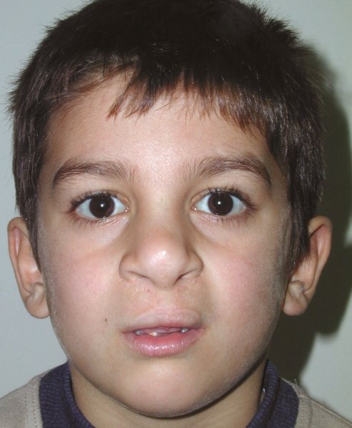 Расщелина верхней губы до и после