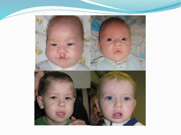 Уранопластика Оперативная хирургия