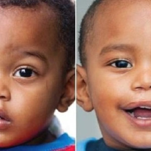 Косая расщелина лица колобома