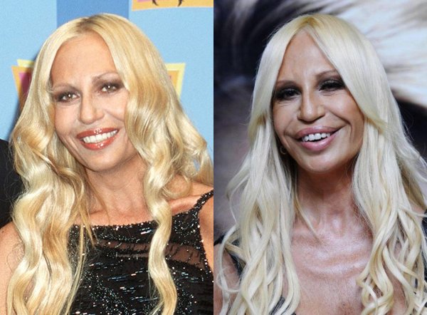 Донателла Версаче до и после пластики 2020