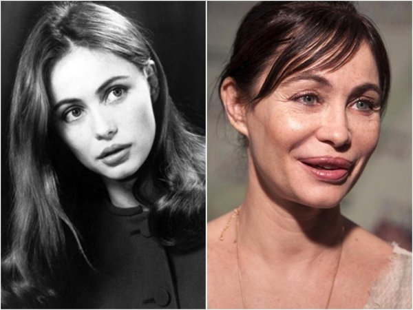 Эммануэль Беар до операции