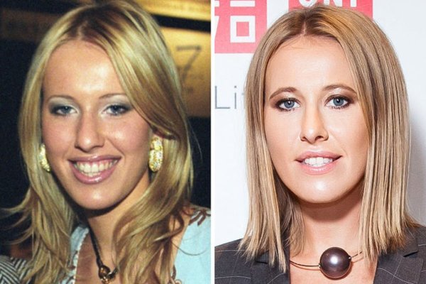 Ксения Собчак ринопластика