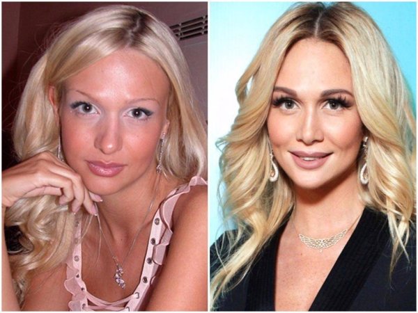 Виктория Лопырева ринопластика