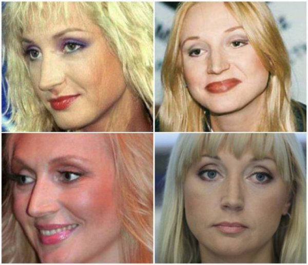 Кристина Орбакайте до пластики