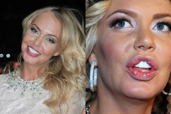 Маша Малиновская после пластики