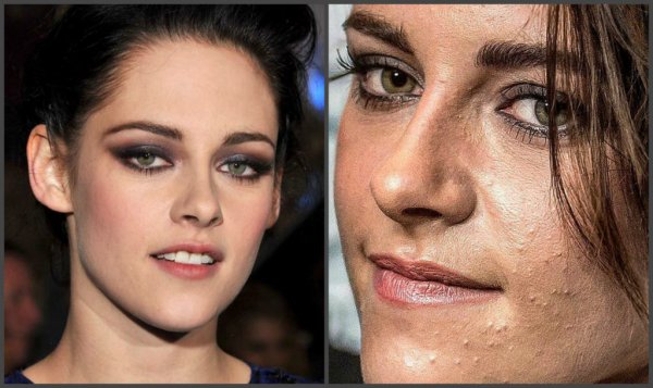 Кристен Стюарт с прыщами