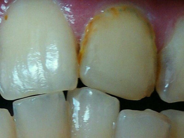 Кленовый мучнистый червец