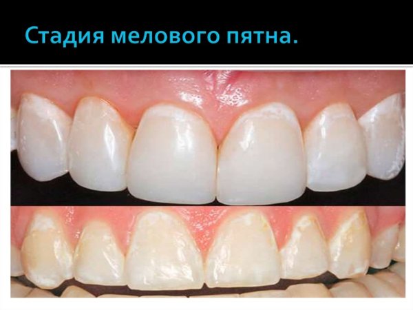 Межзубный пришеечный кариес