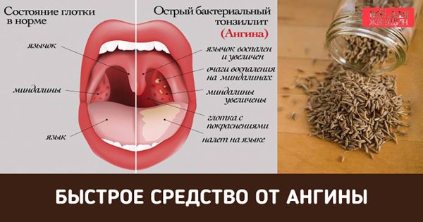 Наследственный несовершенный амелогенез