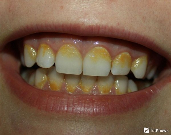 Десквамативный глосси