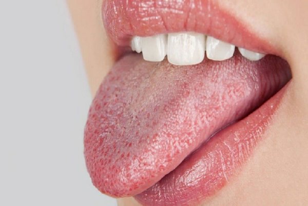 Меловидно крапчатая форма флюороза