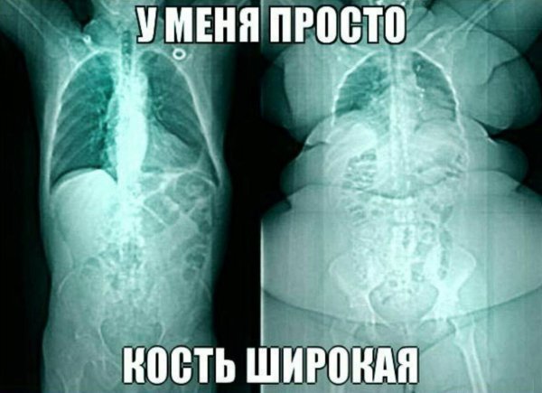 Кость широкая рентген