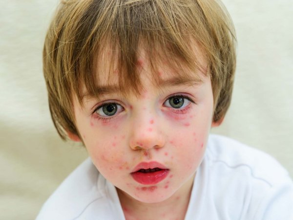 Стрептококковое импетиго