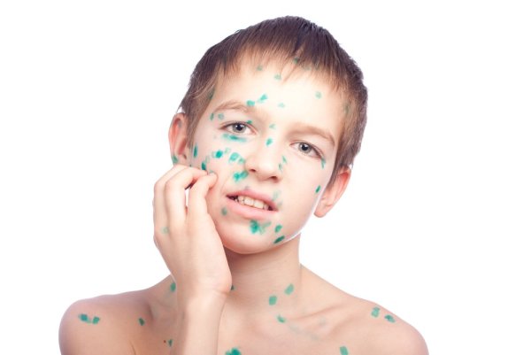 Ветрянка ветряная оспа