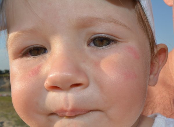 Красные пятна на лице у ребенка