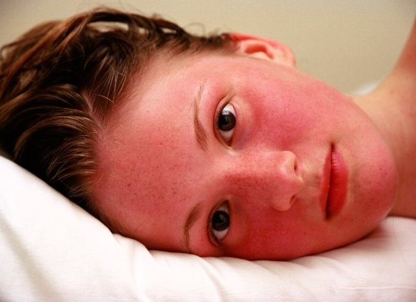 Блашинг синдром (эритрофобия)