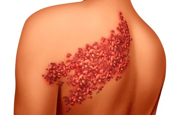 Ветрянка опоясывающий лишай