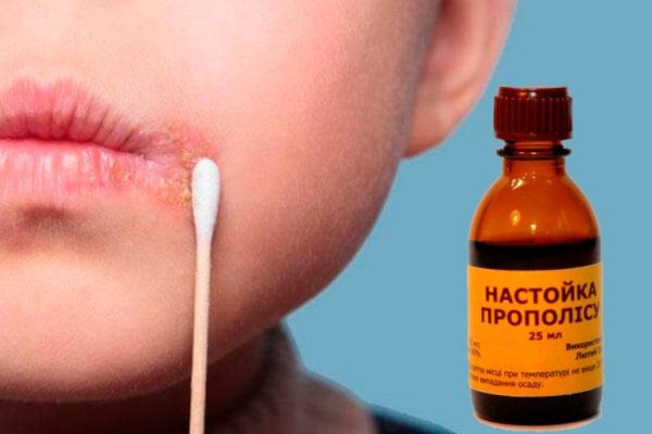 Простуда герпес на лице