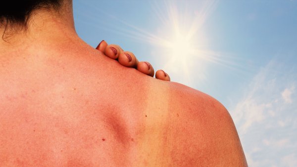 Солнечная крапивница фотодерматит