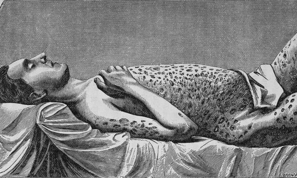 Черная оспа и бубонная чума