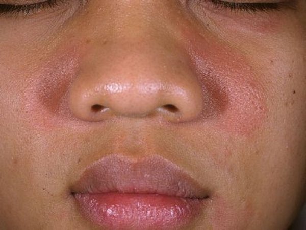 Дескваматозный дерматит