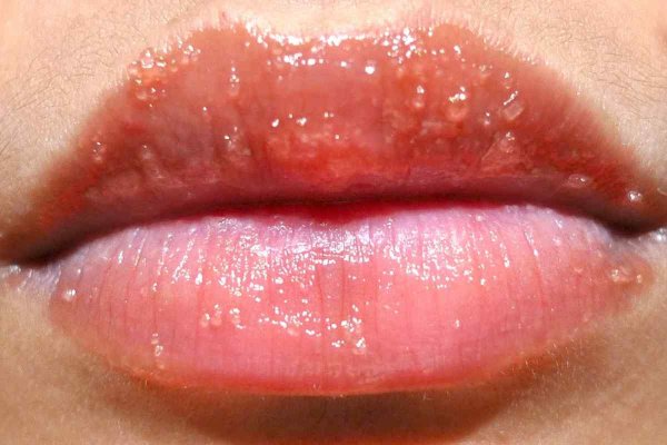 Гранулематозный хейлит Мишера