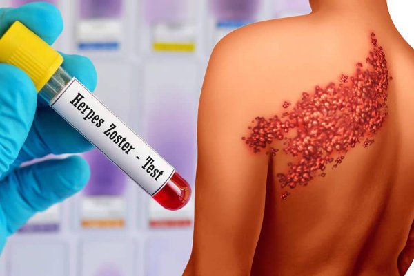 Герпес опоясывающий лишай